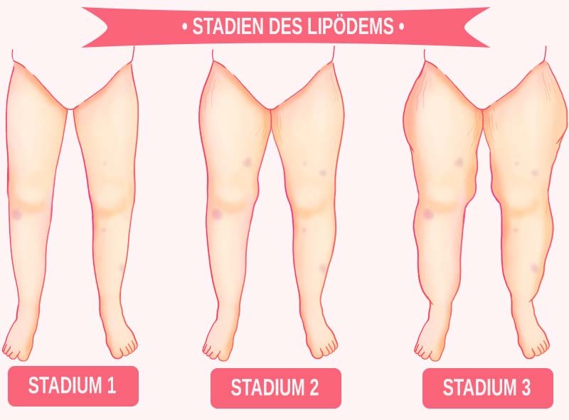Stadien des Lipödem Die drei Stärkegrade des Lipödem